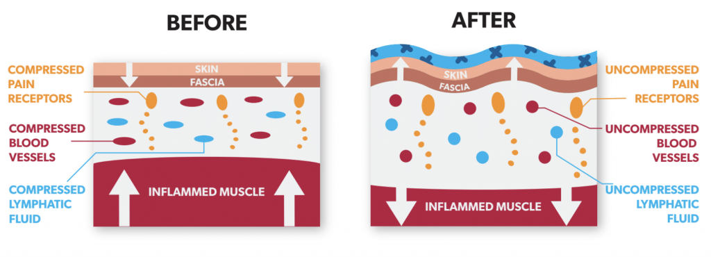 How Does Kinesiology Tape Work? K Tape Effects on the skin diagram showing lifting effect.
